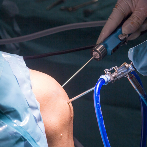 Arthroscopy img